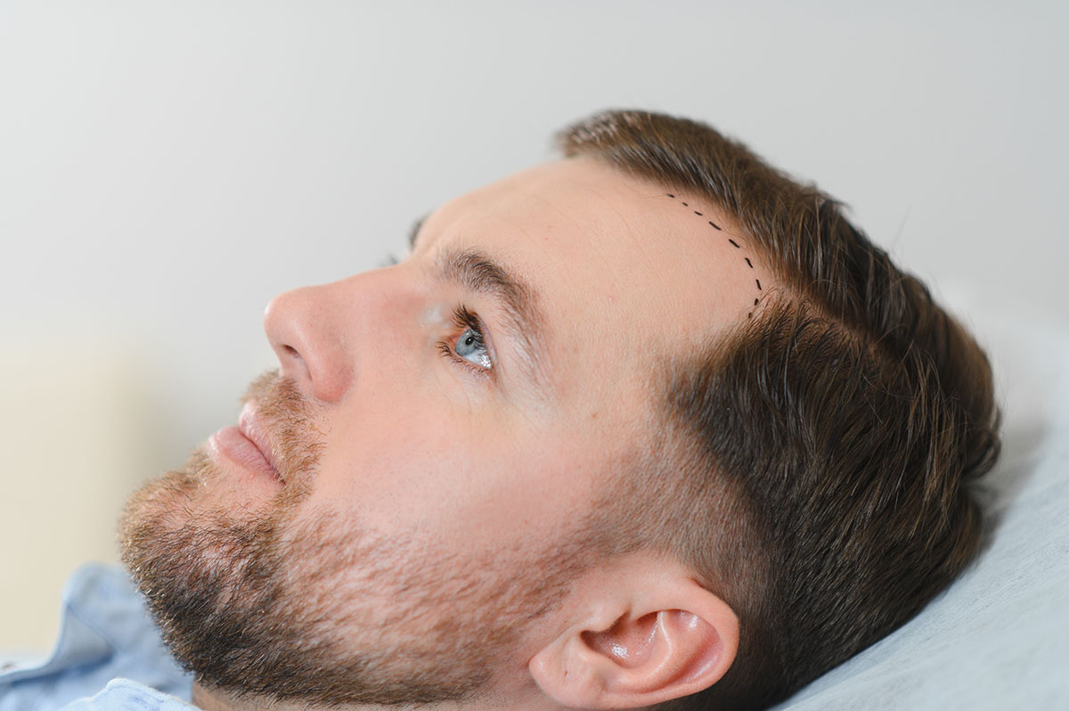 doctor-trichologist-outlines-the-area-of-baldness-2026-03-24-01-27-48-utc